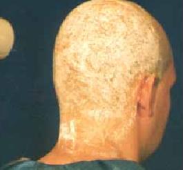 Bald Cap - Step 4